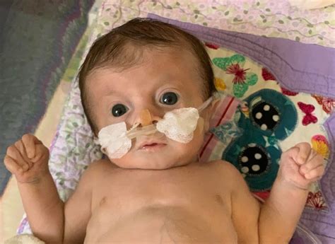 Fetus With Complete Trisomy 18 Syndrome at Nicholas Mckillop blog