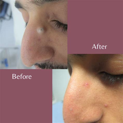 Cyst On Nose Removal Transnasal Endoscopic Excision Of A Dermoid Cyst