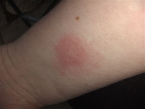 What Are Stress Hives