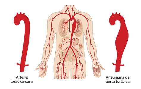 Thoracic aortic aneurysm | ABC Medical Center