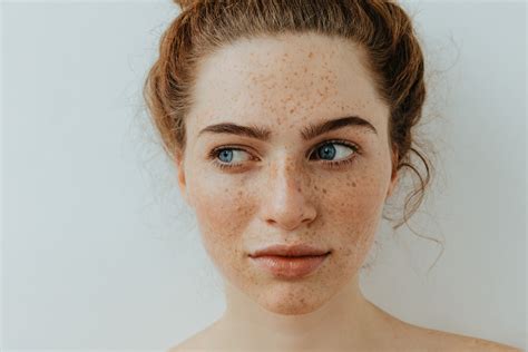 How Do You Get Rid of Freckles? Contour Clinics Guide