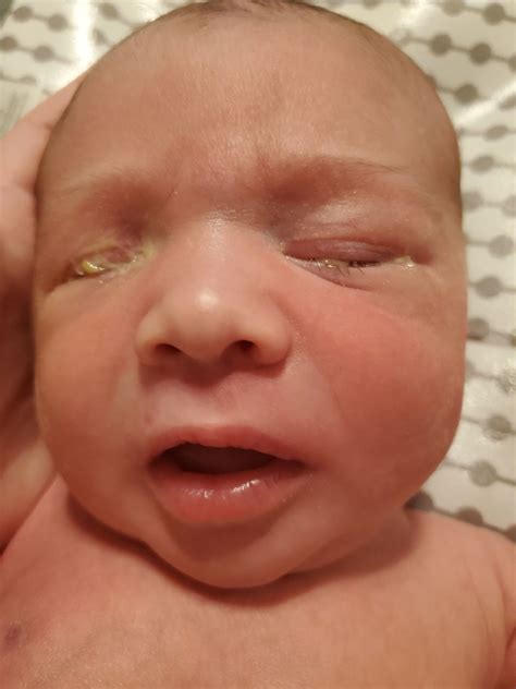 Excessive eye boogers? Clogged tear duct? | BabyCenter