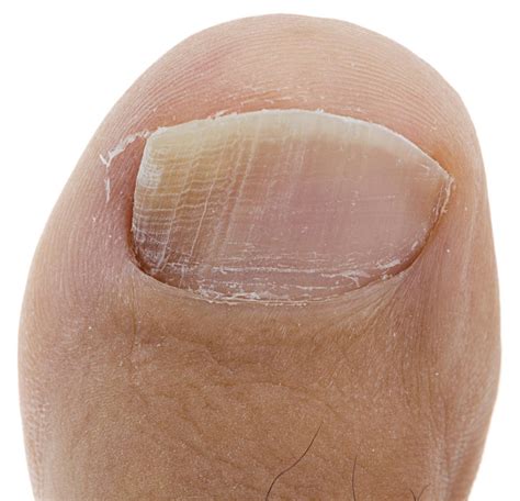 White Chalky Toenails: 7 Causes & Effective Treatments