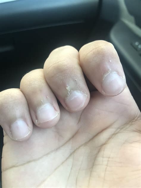 Skin Peeling Around Fingernails