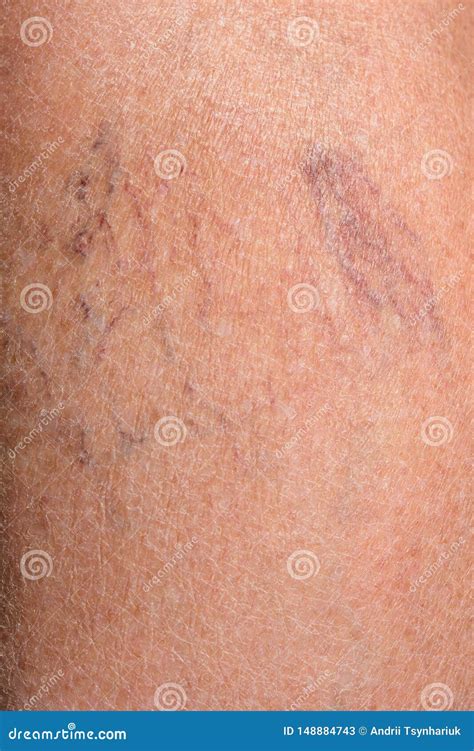Close-up of a Woman`s Legs Old with a Big Bruise after Falling on Ice in the Winter Stock Image ...