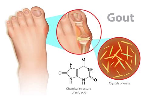 Foot With Gout Appearance at Brock Kyte blog