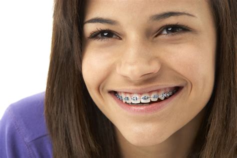 Overbite Correction Braces