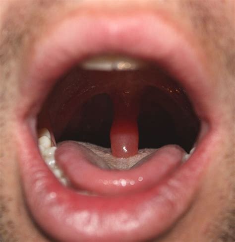 Why Is My Uvula Swollen And Red at Patricia Barker blog