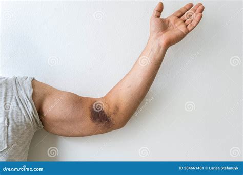 Injury ligament arm bruise stock image. Image of body - 284661481