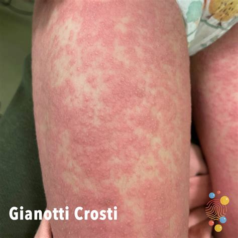 Gianotti-Crosti syndrome - Skin Deep
