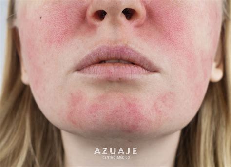 ¿Qué es la rosácea? - Centro Médico Azuaje
