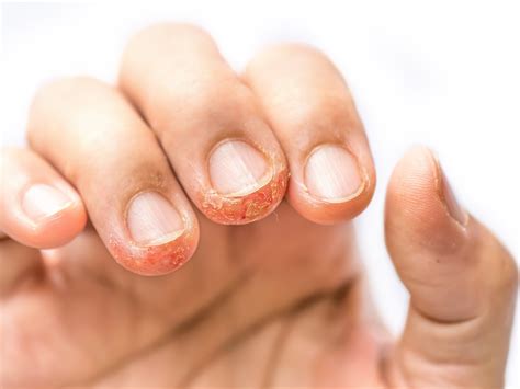 Dyshidrotic Eczema Nail