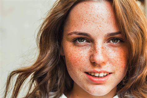 Freckles: Causes and Types