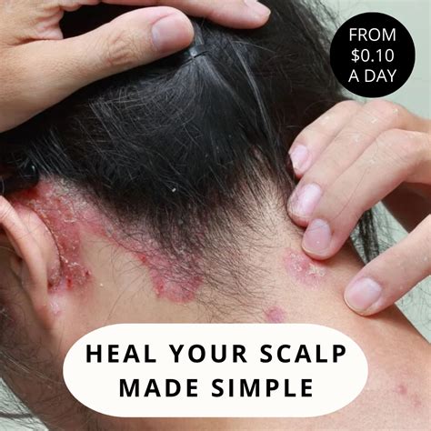 Scalp Care For Your: Psoriasis, Eczema, Itching, Sores, Scabs & Dandruff - 10 Minute Miracle ...