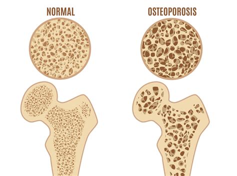 Can Osteoporosis Be Reversed? No, But You Can Prevent Bone Loss | Woman's World