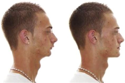 Gender Affirming Facial Surgery–Anatomy and Procedures for Facial Masculinization - Oral and ...