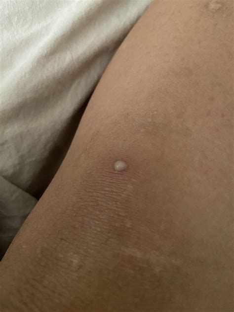 Pimple On Knee