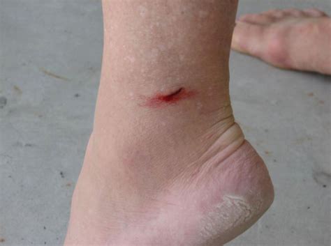 Stingray Sting Foot