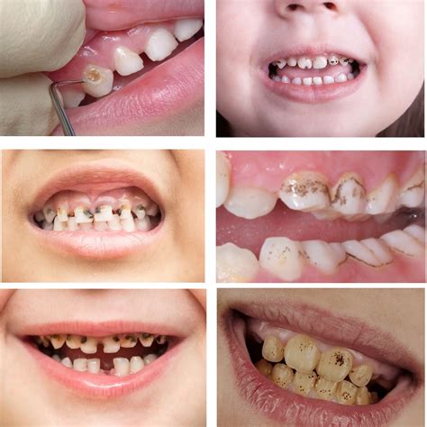 Cavity vs Stain: Understanding the Key Differences Between Cavities and ...