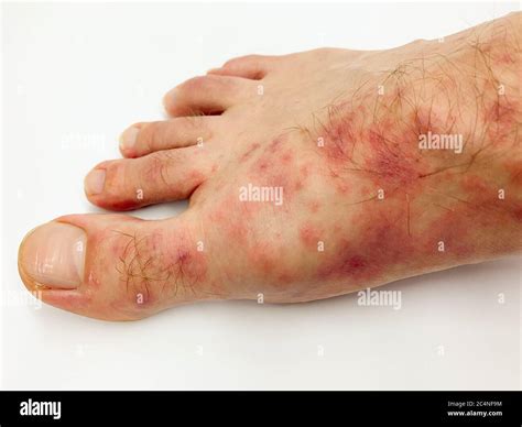 Feet Rash Red at Evelyn Sanchez blog