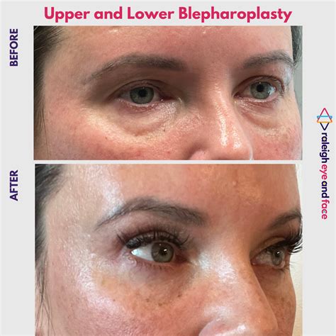 Upper Blepharoplasty Before and After Gallery — Raleigh Eye and Face