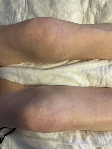Mottling