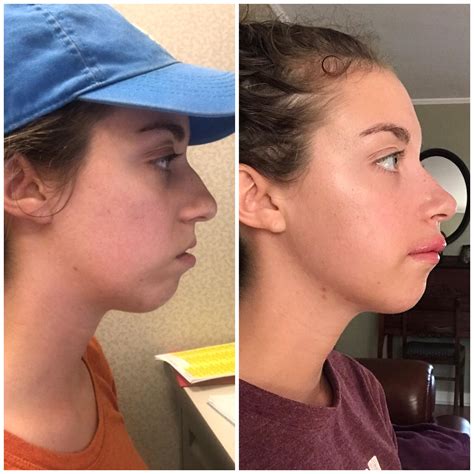 Orthognathic Surgery Testimonials at Patricia Bartholomew blog