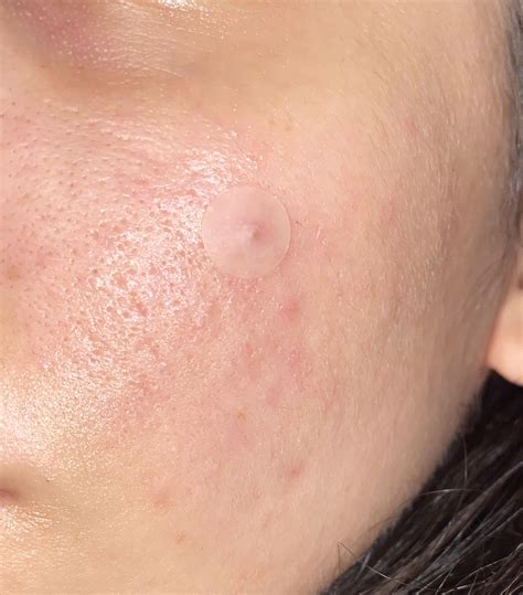 Allergy Little Bumps On Face at Martha Gonzales blog