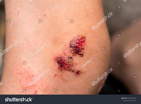 Scratching Skin And Bruising