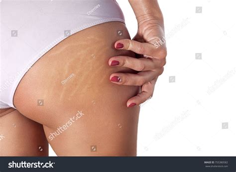 Woman Buttocks Visible Stretch Marks Cellulite Stock Photo 755380582 | Shutterstock