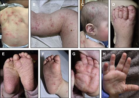 Comparison of Permethrin-Based Treatment Strategies against Scabies in ...