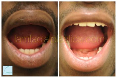 Before and After an Upper Lip Reduction #upperlip #upperlipreduction #lipreductionsurgery # ...