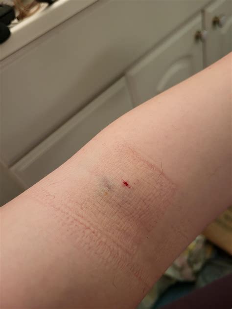 My vein collapsed while donating plasma earlier this week. Here's how ...