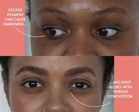 Puffy Eyes, Dark Circles, and Bags: Dermatologists Explain the Difference | SELF