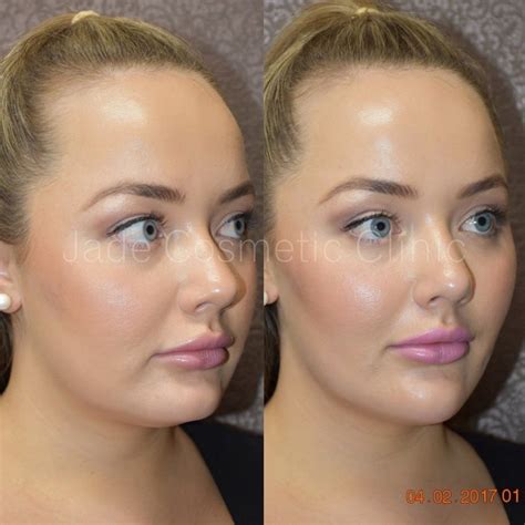 Voluminous Facial Filler