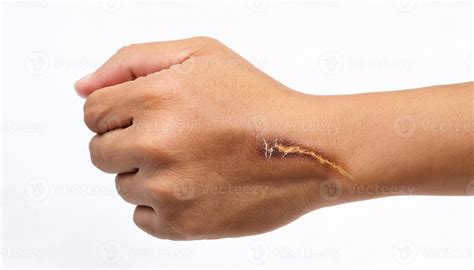 Macro view of a circular scar from a cigarette burn on the wrist ...