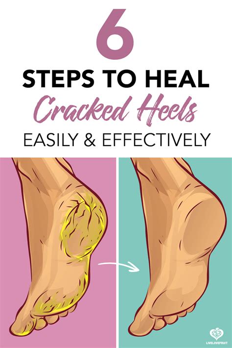 How To Treat Cracked Heels