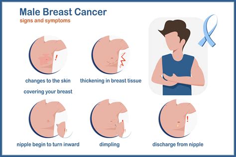 Medical vector illustration.Symptoms of breast cancer in males,thickening in your breast tissue ...