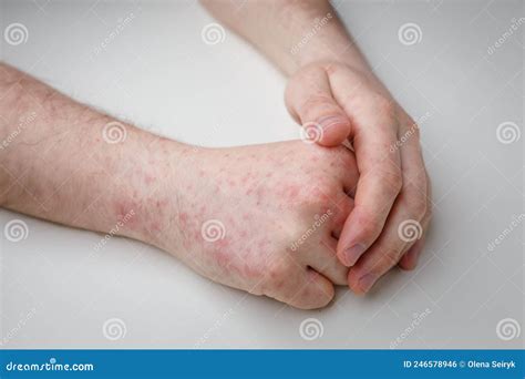 Itchy Rash On Hands