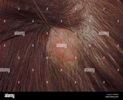 Epidermoid Cyst Scalp