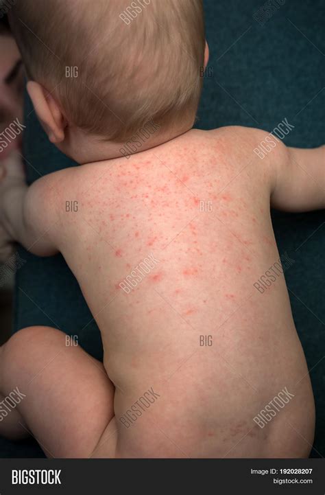 Baby Allergy Rash