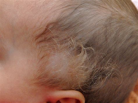 What Is Woolly Hair Syndrome at Toby Skene blog