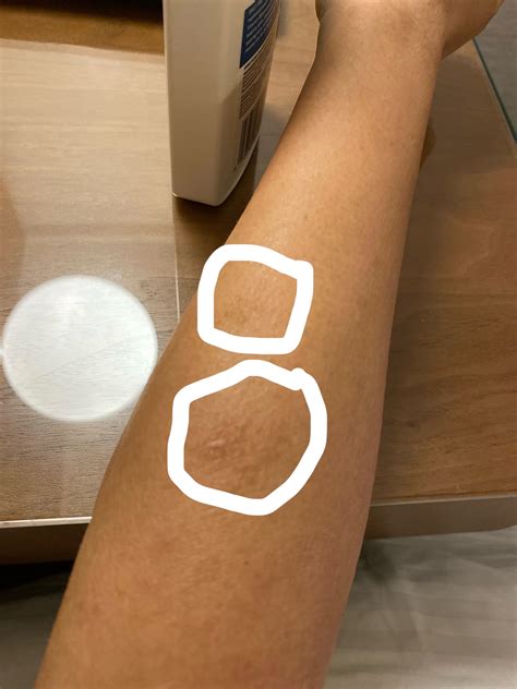 Painful Lump On Forearm Under Skin at Simona Brown blog