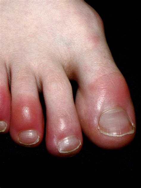 Swollen Painful Toes On One Foot Top Sellers | emergencydentistry.com