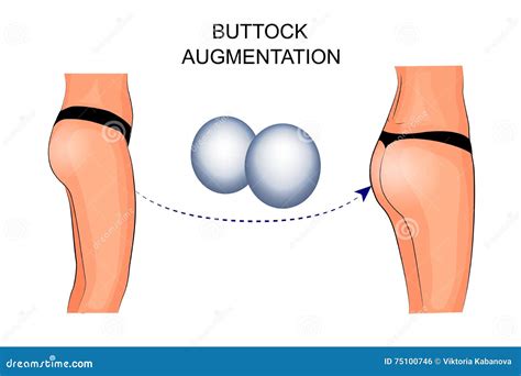 Female Buttocks Implants, Buttock Augmentation Stock Vector - Illustration of breech, healthy ...