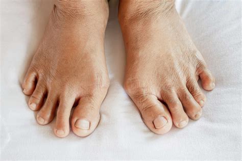 Early Signs of Arthritis in Feet
