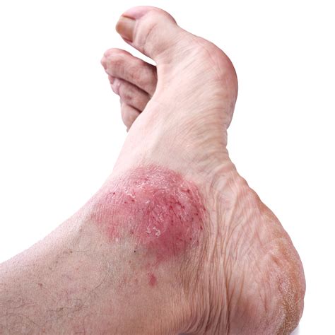 Is Your Foot Rash Psoriasis? | Syracuse Podiatry - Dr. Ryan D'Amico