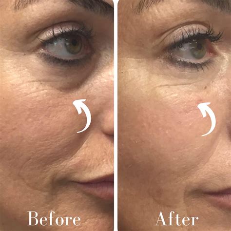 Under Eye Filler Before And After Wrinkles at Vaughn Josephs blog