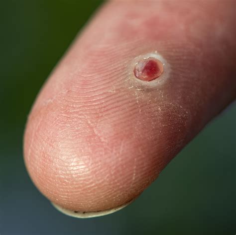 Pyogenic Granuloma Removal | Pyogenic Granuloma Treatment