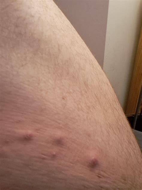 Bumps on inner thigh : r/Skincare_Addiction